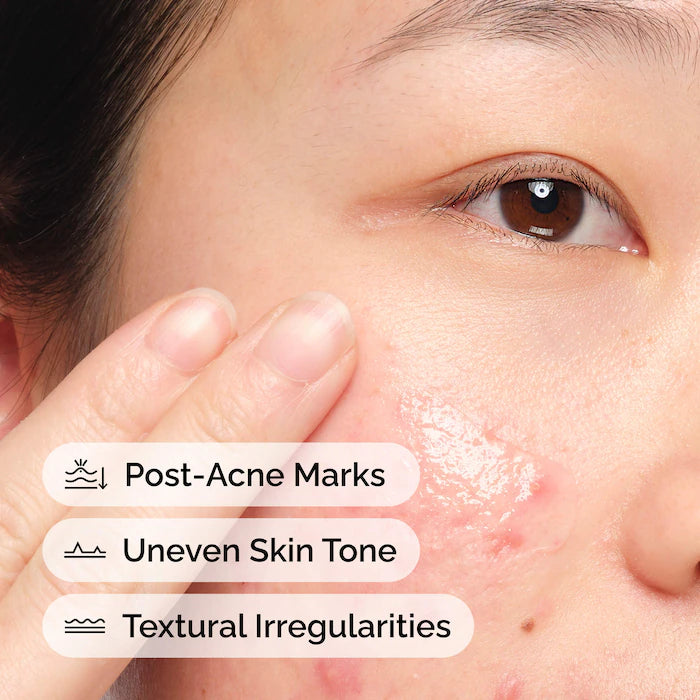 The Ordinary 
Aloe 2% + NAG 2% Solution for Post-Acne Marks