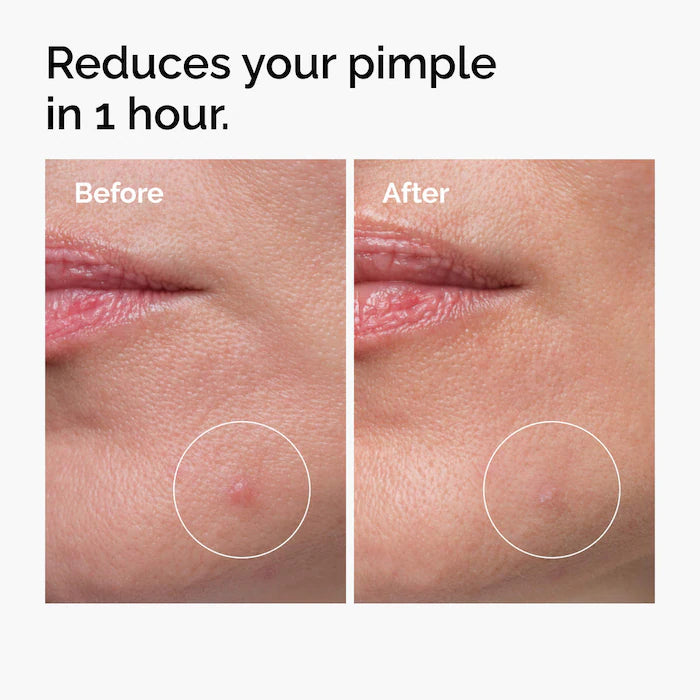 The Ordinary  Sulfur 10% Powder-to-Cream Concentrate Acne Spot Treatment- 5Ml
